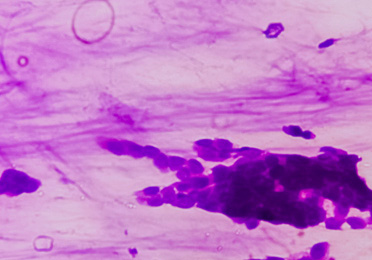 Histologische Aufnahme „Analkarzinom“ zeigt eine histologische Aufnahme eines Analkarzinoms.