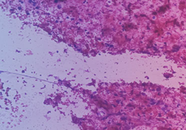 Histologische Aufnahme „Metastasiertes Plattenepithelkarzinom“ zeigt histologische Aufnahme eines metastasierten Plattenepithelkarzinoms.