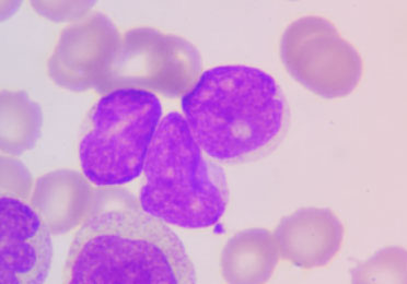 Histologische Aufnahme „Leukämiezellen“ zeigt mikroskopische Aufnahme von abnormen weißen Blutkörperchen.