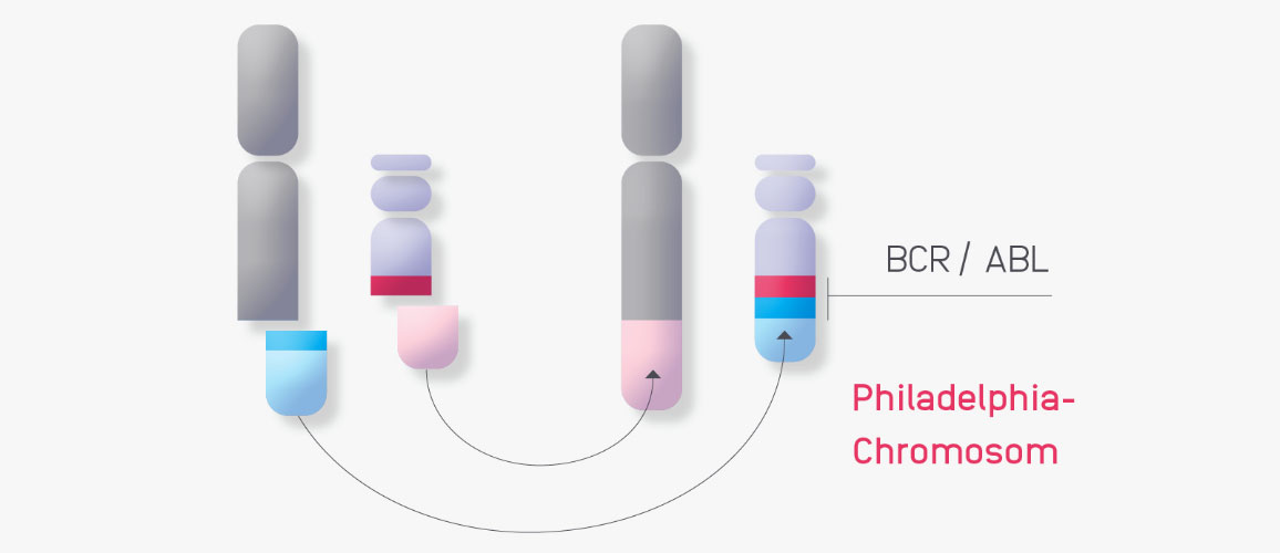 Schematische Darstellung der Chromosomen-Translokation, die zur Bildung des Philadelphia-Chromosoms führt.
