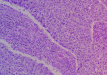 Histologische Aufnahme eines „diffusen großzelligen B-Zell-Lymphom“