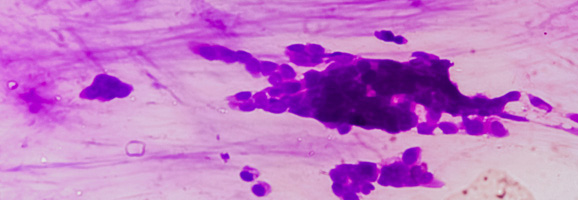 Histologische Aufnahme „Analkarzinom“ zeigt eine histologische Aufnahme eines Analkarzinoms.