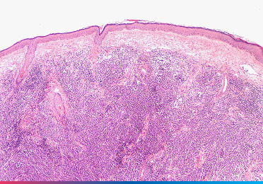 Histologische Aufnahme „Metastasiertes Plattenepithelkarzinom“ zeigt histologische Aufnahme eines metastasierten Plattenepithelkarzinoms.