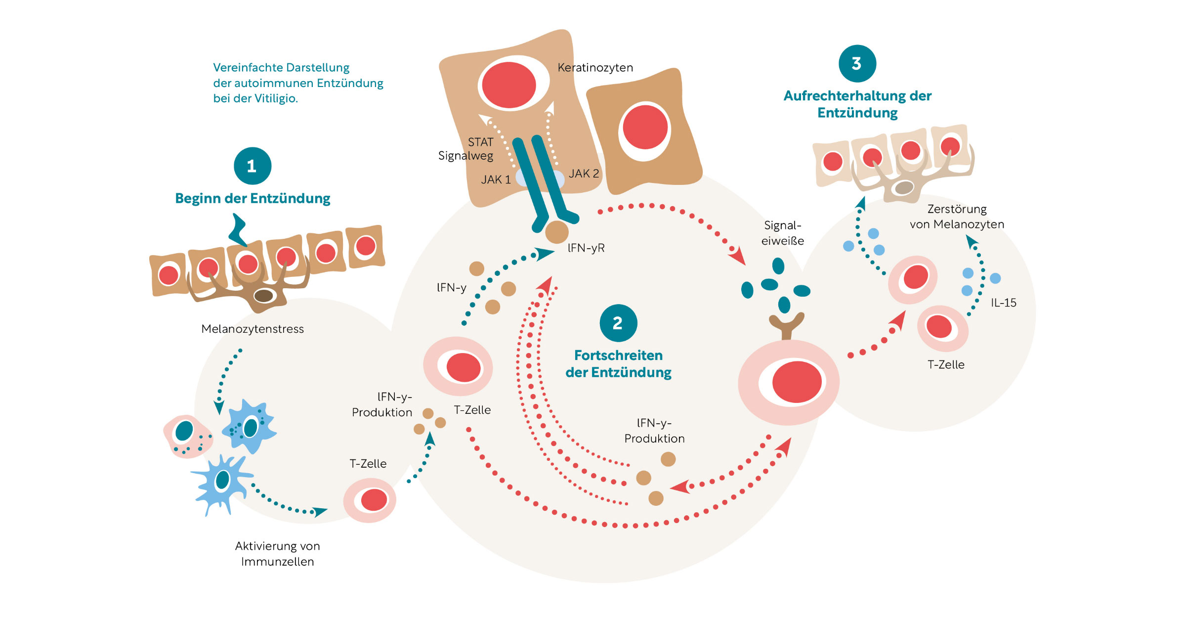 Schematiche Darstellung des Pathomechanismus der nichtsegmentalen Vitiligo