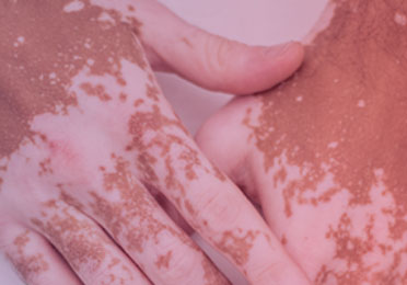 Foto „Autoimmune Entzündungsreaktion bei Vitiligo“ zeigt Haut mit Depigmentierungsarealen