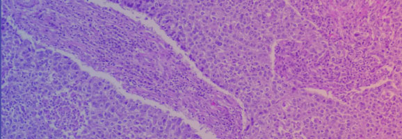 Histologische Aufnahme eines „diffusen großzelligen B-Zell-Lymphom“