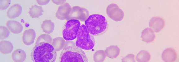 Histologische Aufnahme „Leukämiezellen“ zeigt mikroskopische Aufnahme von abnormen weißen Blutkörperchen.