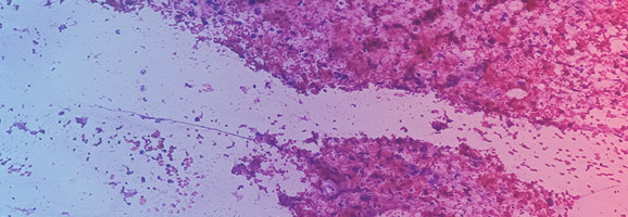 Histologische Aufnahme „Metastasiertes Plattenepithelkarzinom“ zeigt  Histologische Aufnahme eines metastasierten Plattenepithelkarzinoms.