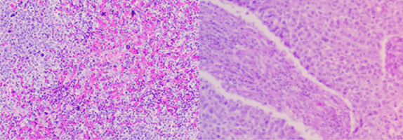 Histologische Aufnahme eines „diffusen großzelligen B-Zell-Lymphom“